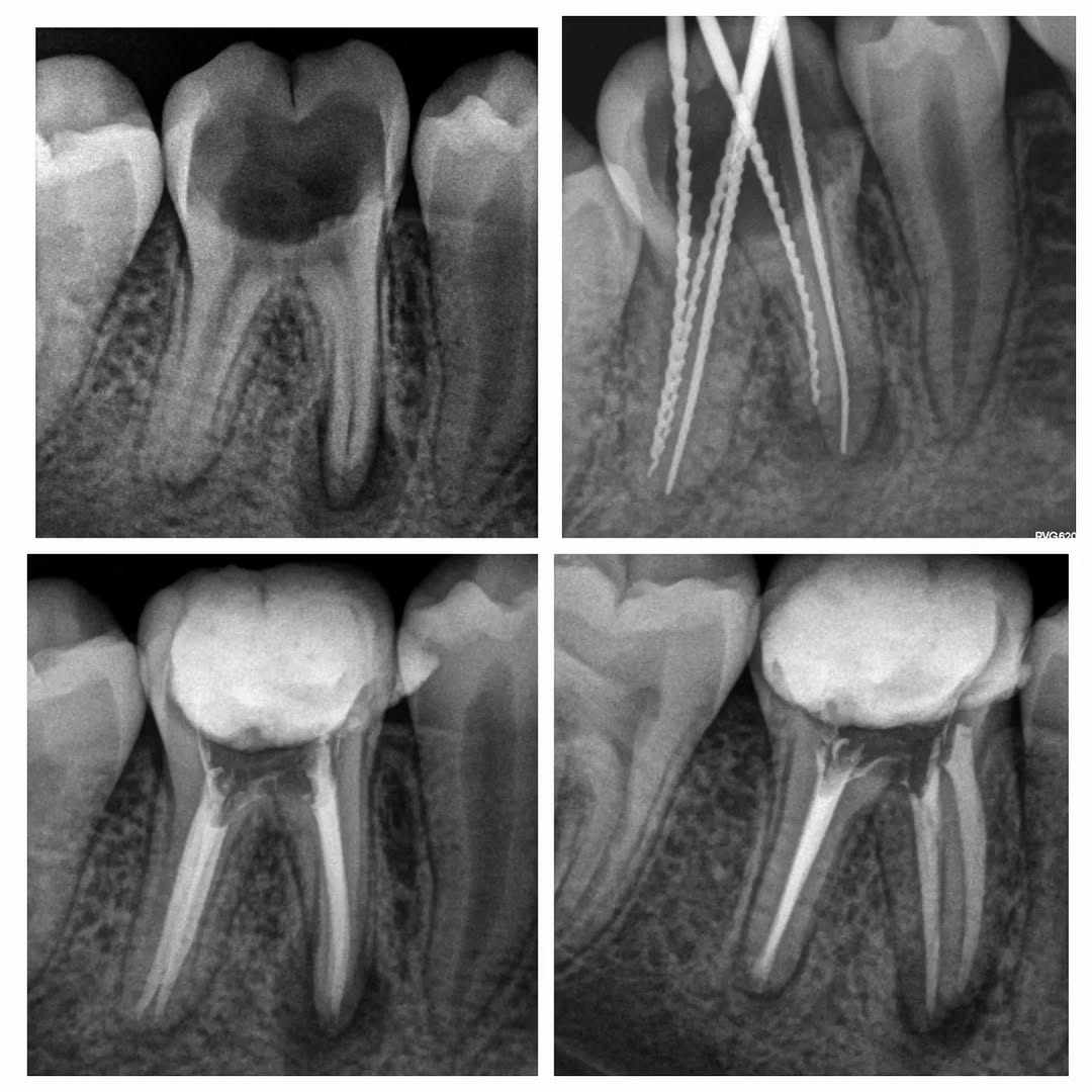 Successful Clinical Case with SUPER fILES III by DENCO