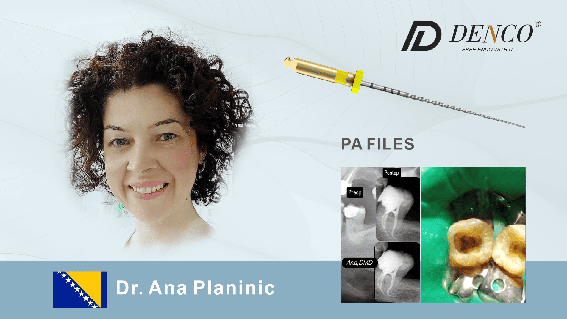 How PA FILES Revolutionized Treatment of a Complex Curved Root Canal